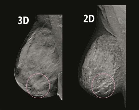 the villages breast mammogram|3D Mammography .